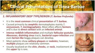 Tinea Barbae Clinical Presentation: History, Physical Examination