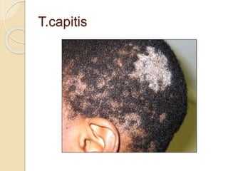 Fungal Infections/ Mycoses ppt by Dr.C.P.PRINCE | PPTX