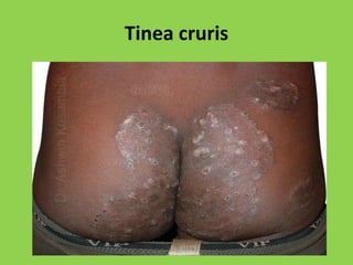 Tinea cruris
 