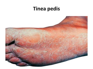 Tinea pedis
 