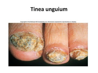 Tinea unguium
 