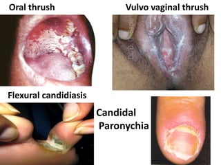 Oral thrush
Flexural candidiasis
Vulvo vaginal thrush
Candidal
Paronychia
 