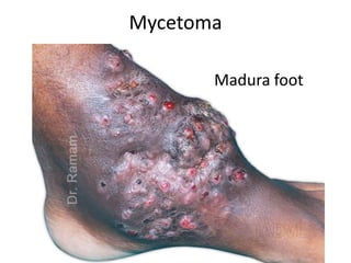 Mycetoma
Madura foot
 