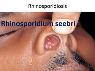 Rhinosporidiosis
Rhinosporidium seebri
 