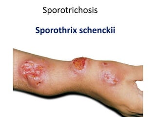 Sporotrichosis
Sporothrix schenckii
 