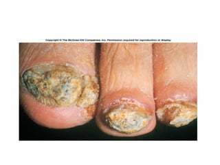 Fungal infections prenav