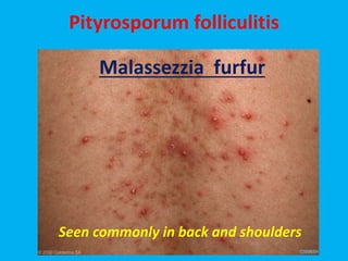 Pityrosporum folliculitis
Malassezzia furfur
Seen commonly in back and shoulders
 