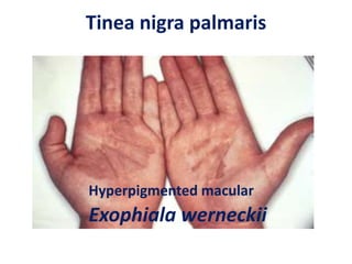 Tinea nigra palmaris
Exophiala werneckii
Hyperpigmented macular
 