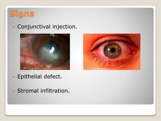 Signs
 Conjunctival injection.
 Epithelial defect.
 Stromal infiltration.
 