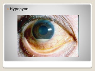  Hypopyon
 