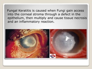Fungal Keratitis is caused when Fungi gain access
into the corneal stroma through a defect in the
epithelium, then multiply and cause tissue necrosis
and an inflammatory reaction.
 