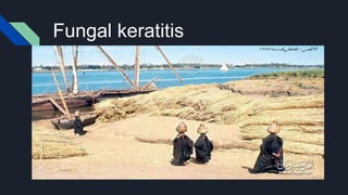 Fungal keratitis
 