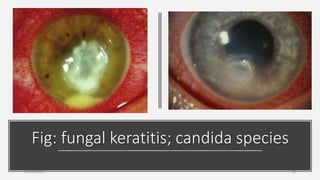 Fig: fungal keratitis; candida species
26-06-2020 10
 