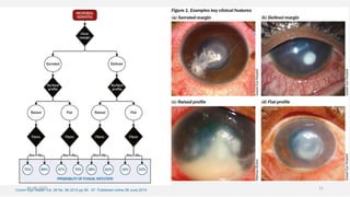 Comm Eye Health Vol. 28 No. 89 2015 pp 06 - 07. Published online 08 June 2015
26-06-2020 11
 