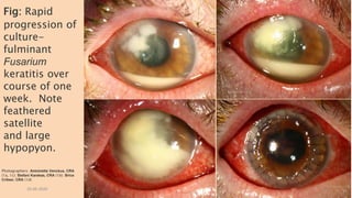 Fig: Rapid
progression of
culture-
fulminant
Fusarium
keratitis over
course of one
week. Note
feathered
satellite
and large
hypopyon.
Photographers: Antoinette Venckus, CRA
(1a, 1c); Stefani Karakas, CRA (1b); Brice
Critser, CRA (1d)
26-06-2020 8
 