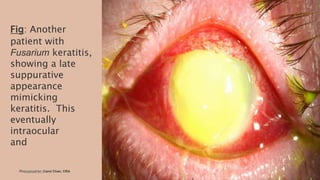Fig: Another
patient with
Fusarium keratitis,
showing a late
suppurative
appearance
mimicking
keratitis. This
eventually
intraocular
and
Photographer: Carol Chan, CRA26-06-2020 9
 
