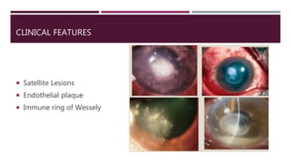 CLINICAL FEATURES
 Satellite Lesions
 Endothelial plaque
 Immune ring of Wessely
 