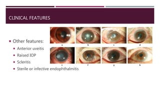 CLINICAL FEATURES
 Other features:
 Anterior uveitis
 Raised IOP
 Scleritis
 Sterile or infective endophthalmitis
 