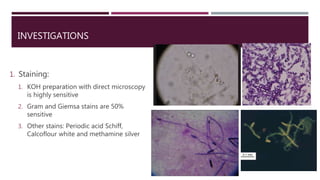 INVESTIGATIONS
1. Staining:
1. KOH preparation with direct microscopy
is highly sensitive
2. Gram and Giemsa stains are 50%
sensitive
3. Other stains: Periodic acid Schiff,
Calcoflour white and methamine silver
 