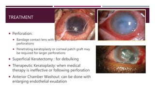 TREATMENT
 Perforation:
 Bandage contact lens with glue for smaller
perforations
 Penetrating keratoplasty or corneal patch graft may
be required for larger perforations
 Superficial Keratectomy : for debulking
 Therapeutic Keratoplasty: when medical
therapy is ineffective or following perforation
 Anterior Chamber Washout: can be done with
enlarging endothelial exudation
 