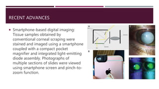 RECENT ADVANCES
 Smartphone-based digital imaging:
Tissue samples obtained by
conventional corneal scraping were
stained and imaged using a smartphone
coupled with a compact pocket
magnifier and integrated light-emitting
diode assembly. Photographs of
multiple sections of slides were viewed
using smartphone screen and pinch-to-
zoom function.
 