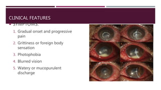 CLINICAL FEATURES
 SYMPTOMS:
1. Gradual onset and progressive
pain
2. Grittiness or foreign body
sensation
3. Photophobia
4. Blurred vision
5. Watery or mucopurulent
discharge
 