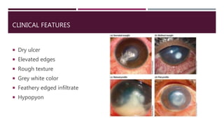 CLINICAL FEATURES
 Dry ulcer
 Elevated edges
 Rough texture
 Grey white color
 Feathery edged infiltrate
 Hypopyon
 