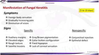Dr. Tukezban Huseynova
Manifestation of Fungal Keratitis
v Foreign body sensation
v Gradually increasing pain
v Diminution of vision
Nonspecific
Symptoms
Clinical presentation
Signs
Specific
v Feathery margins
v Elevated edges
v Rough texture
v Satellite lessions
v Gray/Brown pigmentation
v Collar button configuration
v Fixed Hypopion
v Lack of corneal sensation
v Conjunctival injection
v Epithelial defect
(5 to 10 days)
 