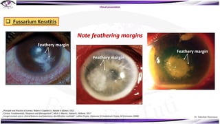 Dr. Tukezban Huseynova
Branching
vesicular
lesion
Clinical presentation
q Fussarium Keratitis
Feathery margin
Feathery margin
Feathery margin
Note feathering margins
„Principle and Practice of cornea, Robert A Copelnd Jr, Natalie A Afshari, 2013
„Cornea: Fundamentals, Diagnosis and Management“, Mark J. Mannis, Edward J. Holland, 2017
„Fungal corneal ulcers: clinical features and laboratory identification methods“, Lalitha Prajna, Vijakumar N Venkatesch Prajna, M Srinivasan (2008)
 