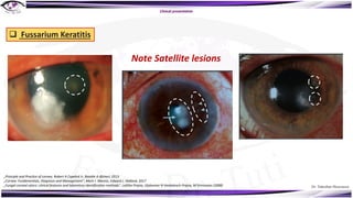 Dr. Tukezban Huseynova
Clinical presentation
Note Satellite lesions
q Fussarium Keratitis
„Principle and Practice of cornea, Robert A Copelnd Jr, Natalie A Afshari, 2013
„Cornea: Fundamentals, Diagnosis and Management“, Mark J. Mannis, Edward J. Holland, 2017
„Fungal corneal ulcers: clinical features and laboratory identification methods“, Lalitha Prajna, Vijakumar N Venkatesch Prajna, M Srinivasan (2008)
 