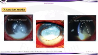 Dr. Tukezban Huseynova
Branching vesicular
lesion
Clinical presentation
Double layered hypopion Double layered hypopion
Thick plaque
q Fussarium Keratitis
„Fungal corneal ulcers: clinical features and laboratory identification methods“, Lalitha Prajna, Vijakumar N Venkatesch Prajna, M Srinivasan (2008)
 