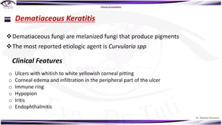 Dr. Tukezban Huseynova
Branching vesicular
lesion
Clinical presentation
Dematiaceous Keratitis
vDematiaceous fungi are melanized fungi that produce pigments
vThe most reported etiologic agent is Curvularia spp
Clinical Features
o Ulcers with whitish to white yellowish corneal pitting
o Corneal edema and infiltration in the peripheral part of the ulcer
o Immune ring
o Hypopion
o Iritis
o Endophthalmitis
 