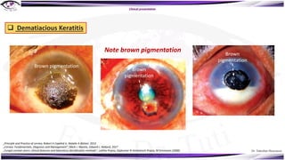 Dr. Tukezban Huseynova
Clinical presentation
q Dematiacious Keratitis
Brown pigmentation
Brown
pigmentation
Brown
pigmentation
Note brown pigmentation
„Principle and Practice of cornea, Robert A Copelnd Jr, Natalie A Afshari, 2013
„Cornea: Fundamentals, Diagnosis and Management“, Mark J. Mannis, Edward J. Holland, 2017
„Fungal corneal ulcers: clinical features and laboratory identification methods“, Lalitha Prajna, Vijakumar N Venkatesch Prajna, M Srinivasan (2008)
 