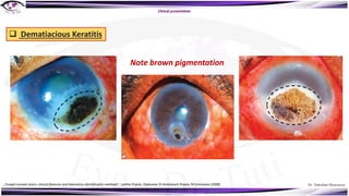 Dr. Tukezban Huseynova
Clinical presentation
q Dematiacious Keratitis
Note brown pigmentation
„Fungal corneal ulcers: clinical features and laboratory identification methods“, Lalitha Prajna, Vijakumar N Venkatesch Prajna, M Srinivasan (2008)
 