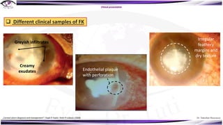 Dr. Tukezban Huseynova
Branching vesicular
lesion
Clinical presentation
Greyish infiltrates
Creamy
exudates
Irregular
feathery
margins and
dry texture
Endothelial plaque
with perforation
q Different clinical samples of FK
„Corneal ulcers diagnosis and management“, Hugh R Taylor, Peter R Laibson (2008)
 