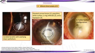 Dr. Tukezban Huseynova
Clinical presentation
A “collar button”
configuration
Candida keratitis with overlying
intact epithelium.
Elevated corneal lesion (1), gray/dirty
white surface, a ring infiltrate (2), and a
hypopyon (3).
q Different clinical samples of FK
„Principle and Practice of cornea, Robert A Copelnd Jr, Natalie A Afshari, 2013
„Corneal ulcers diagnosis and management“, Hugh R Taylor, Peter R Laibson (2008)
„Cornea: Fundamentals, Diagnosis and Management“, Mark J. Mannis, Edward J. Holland, 2017
 