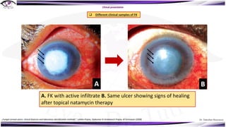 Dr. Tukezban Huseynova
Clinical presentation
A. FK with active infiltrate B. Same ulcer showing signs of healing
after topical natamycin therapy
q Different clinical samples of FK
„Fungal corneal ulcers: clinical features and laboratory identification methods“, Lalitha Prajna, Vijakumar N Venkatesch Prajna, M Srinivasan (2008)
A B
 