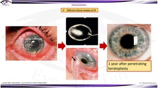 Dr. Tukezban Huseynova
Clinical presentation
q Different clinical samples of FK
1 year after penetrating
keratoplasty
deep infiltrate
„Cornea Atlas, Third Edition“, Jay H Krachmer, David A Palay (2014)
 