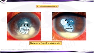 Dr. Tukezban Huseynova
Clinical presentation
q Different clinical samples of FK
Deposits
Deposits
Natamycin (eye drops) deposits
„Fungal corneal ulcers: clinical features and laboratory identification methods“, Lalitha Prajna, Vijakumar N Venkatesch Prajna, M Srinivasan (2008)
 
