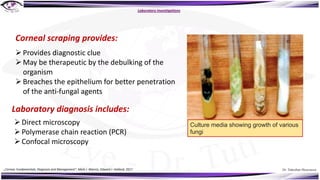 Dr. Tukezban Huseynova
Laboratory investigations
ØProvides diagnostic clue
ØMay be therapeutic by the debulking of the
organism
ØBreaches the epithelium for better penetration
of the anti-fungal agents
Corneal scraping provides:
Laboratory diagnosis includes:
ØDirect microscopy
ØPolymerase chain reaction (PCR)
ØConfocal microscopy
Culture media showing growth of various
fungi
„Cornea: Fundamentals, Diagnosis and Management“, Mark J. Mannis, Edward J. Holland, 2017
 