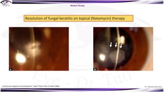 Dr. Tukezban Huseynova
Medical Therapy
Resolution of fungal keratitis on topical (Natamycin) therapy
„Corneal ulcers diagnosis and management“, Hugh R Taylor, Peter R Laibson (2008)
 