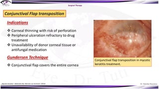 Dr. Tukezban Huseynova
Surgical Therapy
Conjunctival Flap transposition
v Corneal thinning with risk of perforation
v Peripheral ulceration refractory to drug
treatment
v Unavailability of donor corneal tissue or
antifungal medication
Indications
Gundersen Technique
v Conjunctival flap covers the entire cornea
Conjunctival flap transposition in mycotic
keratitis treatment.
„Mycotic Keratitis“, Mahendra Rai, Marcelo Luis Occhiutto (2019)
 