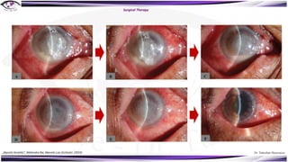 Dr. Tukezban Huseynova
Surgical Therapy
„Mycotic Keratitis“, Mahendra Rai, Marcelo Luis Occhiutto (2019)
 