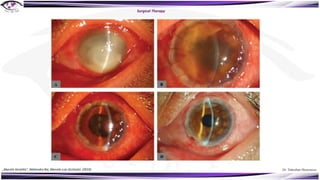 Dr. Tukezban Huseynova
Surgical Therapy
„Mycotic Keratitis“, Mahendra Rai, Marcelo Luis Occhiutto (2019)
 