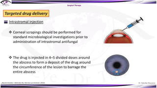 Dr. Tukezban Huseynova
Surgical Therapy
Targeted drug delivery
Intrastromal injection
v The drug is injected in 4–5 divided doses around
the abscess to form a deposit of the drug around
the circumference of the lesion to barrage the
entire abscess
v Corneal scrapings should be performed for
standard microbiological investigations prior to
administration of intrastromal antifungal
„Mycotic Keratitis“, Mahendra Rai, Marcelo Luis Occhiutto (2019)
 