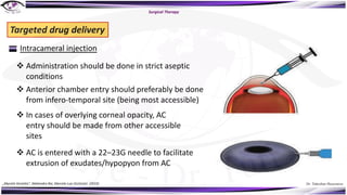 Dr. Tukezban Huseynova
Surgical Therapy
Targeted drug delivery
Intracameral injection
v Administration should be done in strict aseptic
conditions
v Anterior chamber entry should preferably be done
from infero-temporal site (being most accessible)
v In cases of overlying corneal opacity, AC
entry should be made from other accessible
sites
v AC is entered with a 22–23G needle to facilitate
extrusion of exudates/hypopyon from AC
„Mycotic Keratitis“, Mahendra Rai, Marcelo Luis Occhiutto (2019)
 