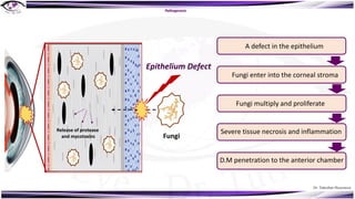 Dr. Tukezban Huseynova
Fungi
Release of protease
and mycotoxins
Epithelium Defect
A defect in the epithelium
Fungi enter into the corneal stroma
Fungi multiply and proliferate
Severe tissue necrosis and inflammation
D.M penetration to the anterior chamber
Pathogenesis
 