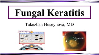 Fungal Keratitis
chalky white infiltrates
Ring infiltrate
Stromal necrosis and
central thinning
Tukezban Huseynova, MD
 