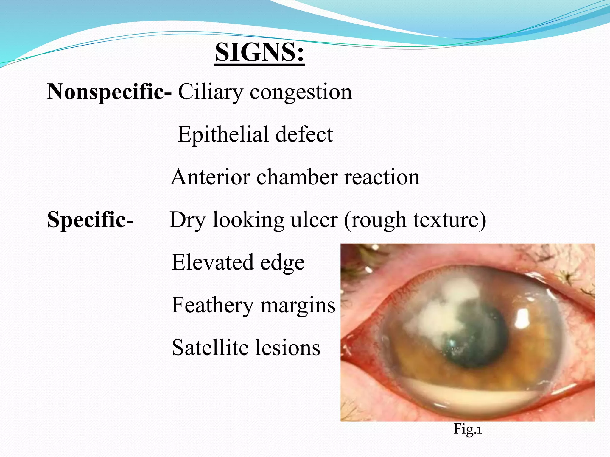 Fungal keratitis | PPTX