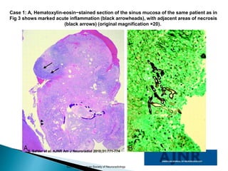 Case 1: A, Hematoxylin-eosin−stained section of the sinus mucosa of the same patient as in
Fig 3 shows marked acute inflammation (black arrowheads), with adjacent areas of necrosis
(black arrows) (original magnification ×20).
S. Safder et al. AJNR Am J Neuroradiol 2010;31:771-774
©2010 by American Society of Neuroradiology
 